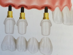 Implantes dentales