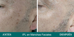 antes y después manchas