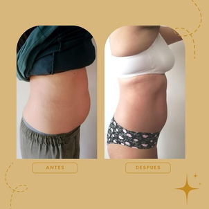 resultados criolipólisis