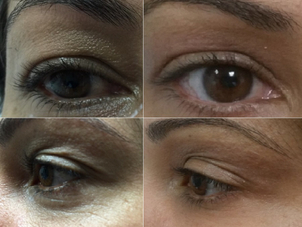 antes y después blefaroplastia sin cirugía