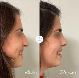 Antes y después de la rinoplastia