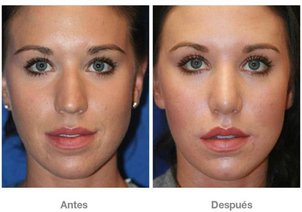 post tratamiento microdermoabrasión