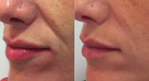 Recuperación relleno facial