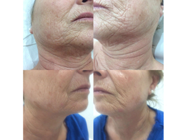 antes y después rejuvenecimiento facial