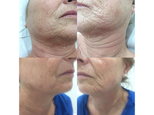 antes y después rejuvenecimiento facial