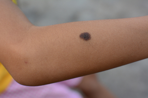 Mancha de nacimiento en el brazo