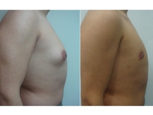 antes y después ginecomastia