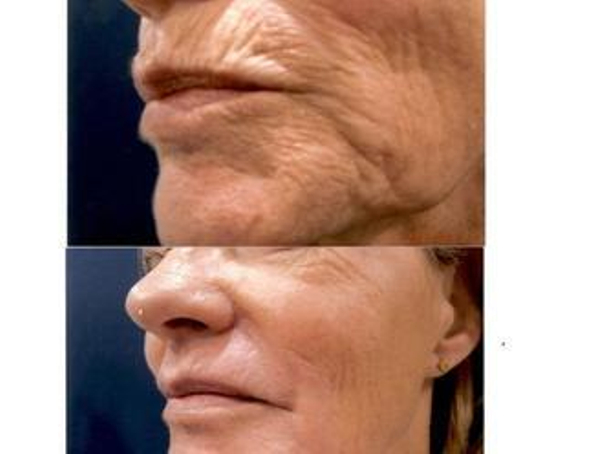 antes y después lifting facial