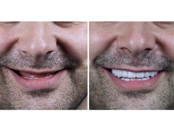 Implante dental, antes y después.