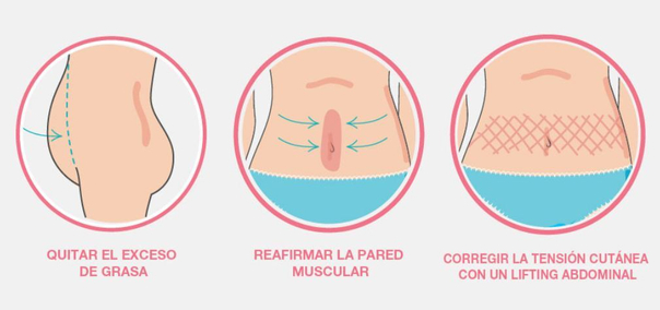 procedimiento abdominoplastia