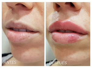 antes y después queiloplastia