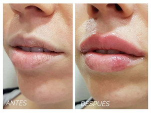 antes y después queiloplastia