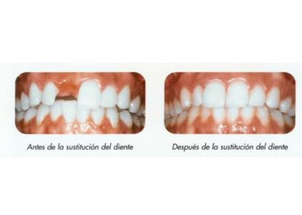 Antes y después implantes dentales