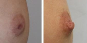 Cirugía de pezones invertidos - antes y después