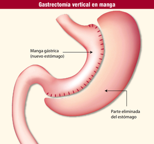 ¿Cómo es el post operatorio y la recuperación de la manga gástrica?