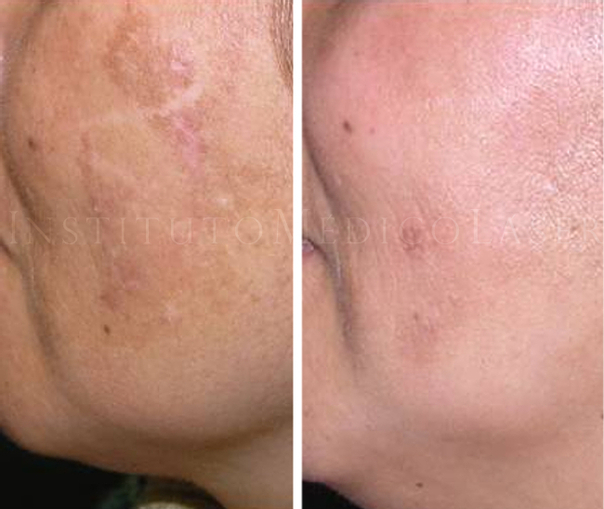 antes y después tratamiento antimanchas