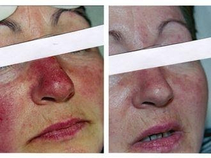 Antes y después del tratamiento de cuperosis