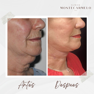 Antes y después liposucción de papada