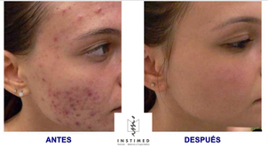 antes y después tratamiento antiacné
