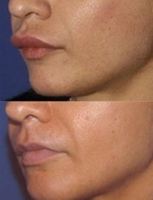 Antes y después queiloplastia