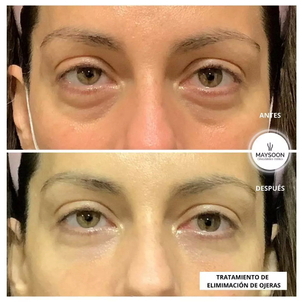 Tratamiento de eliminación de ojeras con láser