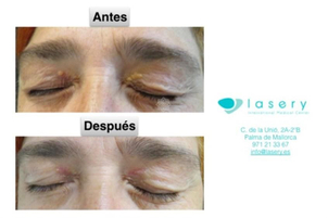 Antes y después del tratamiento de xantalesmas