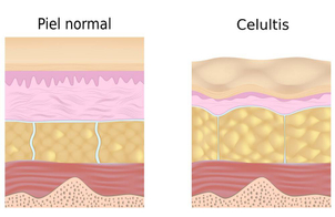 celulitis