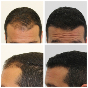 antes y después de microinjertos