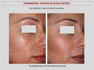 antes y después peeling