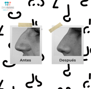 antes y después rinomodelación