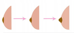 Cirugía de pezones invertidos