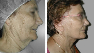 antes y después lifting facial