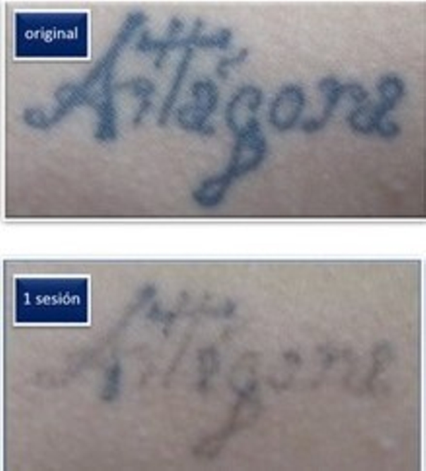 procedimiento eliminación tatuajes