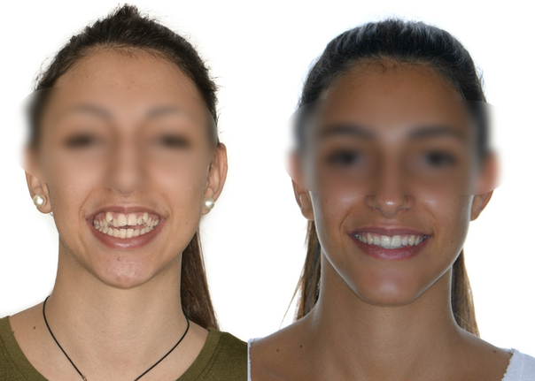 Antes y después de la cirugía maxilofacial