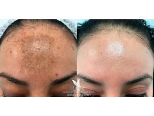 antes y después tratamiento antimanchas