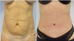 Antes y después abdominoplastia