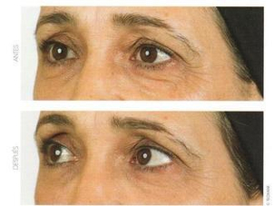 Tratamiento de eliminación de ojeras con láser