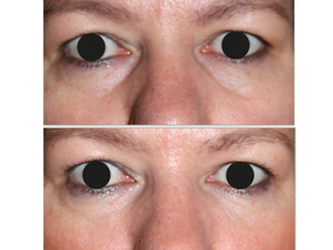 Antes y después tratamiento de ojeras