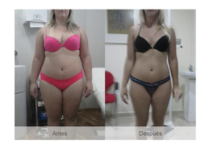 antes y después balón gástrico