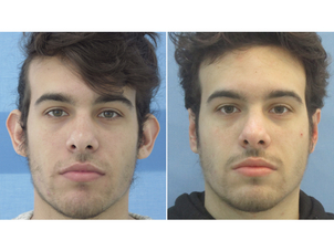 Antes y después de una otoplastia