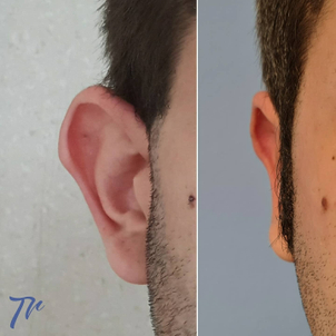 resultado de una otoplastia