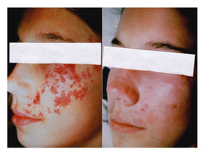 Antes y después angiomas