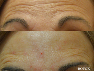resultados toxina botulínica