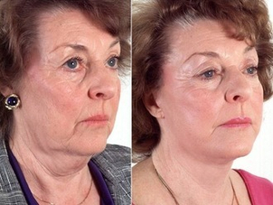 antes y después lifting