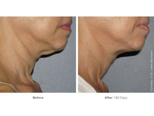 antes y después del hifu