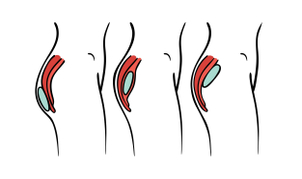 implantes de glúteos con prótesis