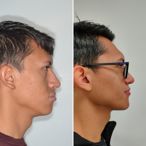 Antes y después de una mentoplastia quirúrgica