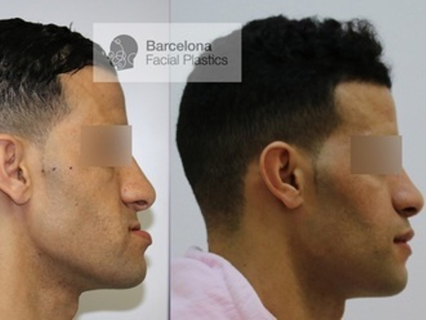 cirugía maxilofacial antes y después