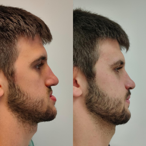antes y después mentoplastia