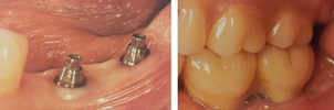 Implantes en masticación superior.